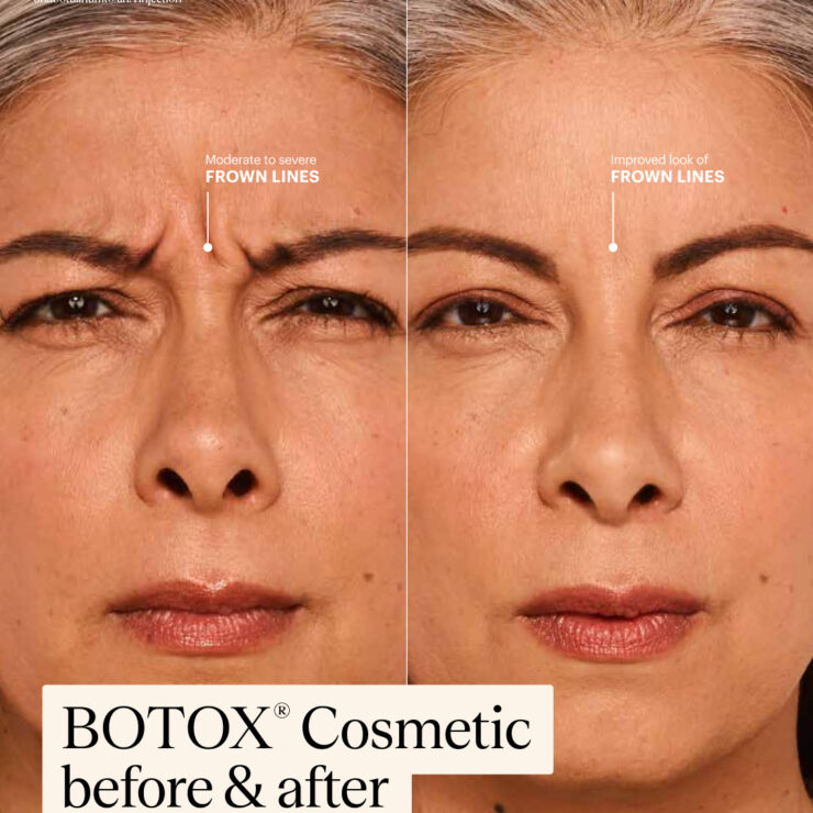 โบท็อกซ์ Allergan (USA) (50 Units)